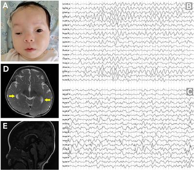 A de novo PUM1 Variant in a Girl With a Dravet-Like Syndrome: Case Report and Literature Review